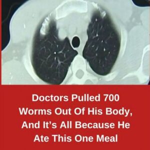 Doctors Pulled 700 Worms Out Of His Body, And It’s All Because He Ate This One Meal