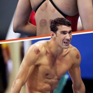 Why Were Olympic Athletes & Other Celebs Spotted with Dark Red Circles on Their Bodies?