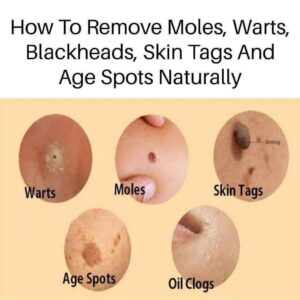 Natural remedies for treating age spots, moles, skin tags, warts, and blackheads Natural remedies for treating age spots, moles, skin tags, warts, and blackheads