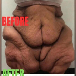 The world’s heaviest woman, who consumed a lot of milkshakes and weighed fifty stone, is no longer recognizable. The world’s heaviest woman, who consumed a lot of milkshakes and weighed fifty stone, is no longer recognizable.