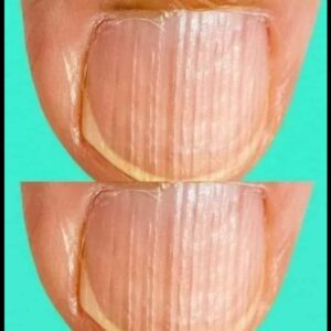 Rippled fingernails reveal secrets of… Rippled fingernails reveal secrets of…
