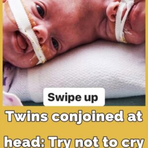 Conjoined twins Abby and Erin Delaney: Inside their remarkable story Conjoined twins Abby and Erin Delaney: Inside their remarkable story