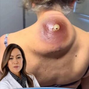 Their Acne Is Severe — But So Is Their Strength Their Acne Is Severe — But So Is Their Strength