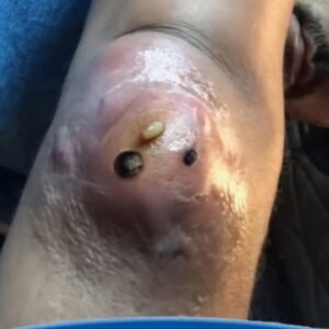 ST, Removal of a fairly large epidermal cyst on the elbow