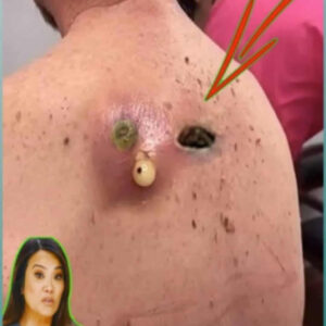 Acne And Everything You Need To Know About Them Acne And Everything You Need To Know About Them